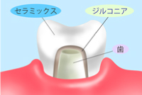 フルジルコニア