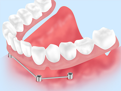 総入れ歯をインプラントで固定する「オーバーデンチャー」