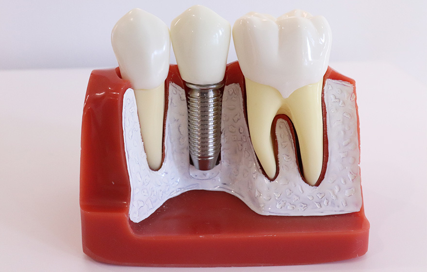 自分の歯のような見た目と機能を回復できるインプラント治療