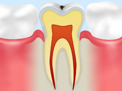 初期の虫歯