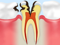 象牙質の虫歯