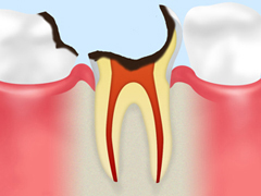 神経に達する虫歯