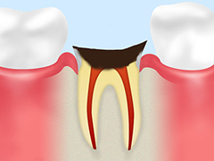 歯根に達する虫歯